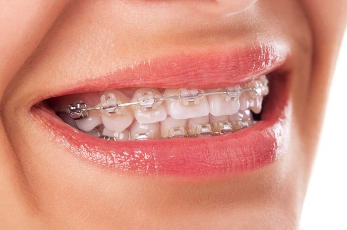 Apakah Gigi Tidak Rata Bisa Menjadi AVSEC Bandara